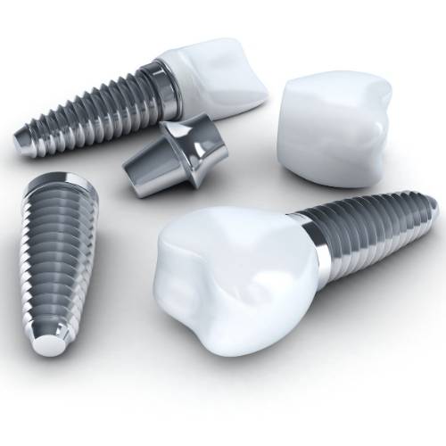 fogaszati-implantatum-beultetesenek-menete-szekesfehervar Fogászati implantátum beültetésének menete Székesfehérvár