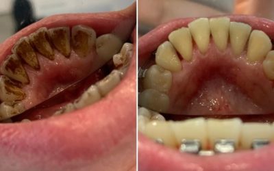 Fogszabályozás melletti dentálhigiéniai kezelés, látványos eredménnyel!