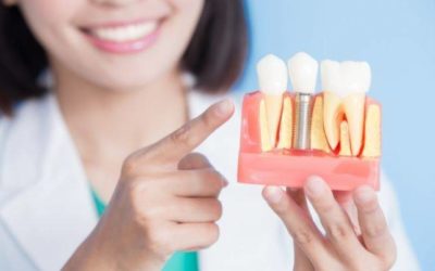 A fogászati implantátum 7 legnagyobb előnye