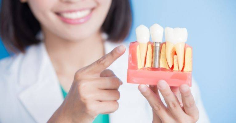 A fogászati implantátum 7 legnagyobb előnye