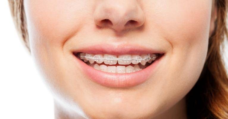 5 tévhit a felnőttkori fogszabályozással kapcsolatban