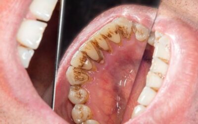 Négy dolog, ami kedvez a fogkő kialakulásának