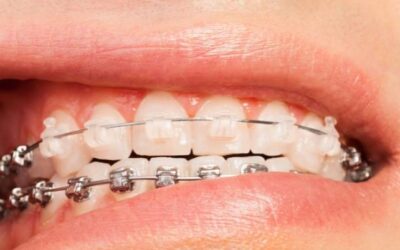 5 tévhit a fogszabályozással kapcsolatban