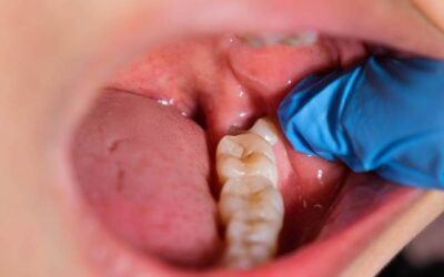 A pericoronitis és kezelése