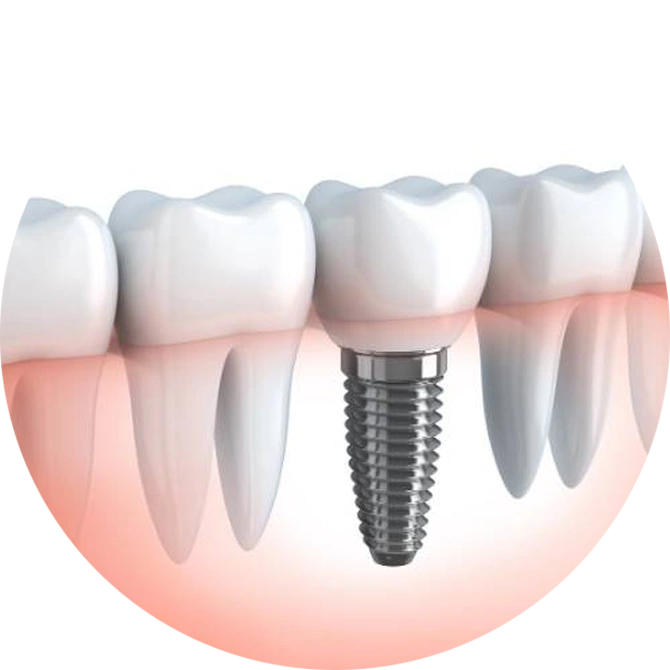 Fogászati implantátum beültetésének menete Székesfehérvár