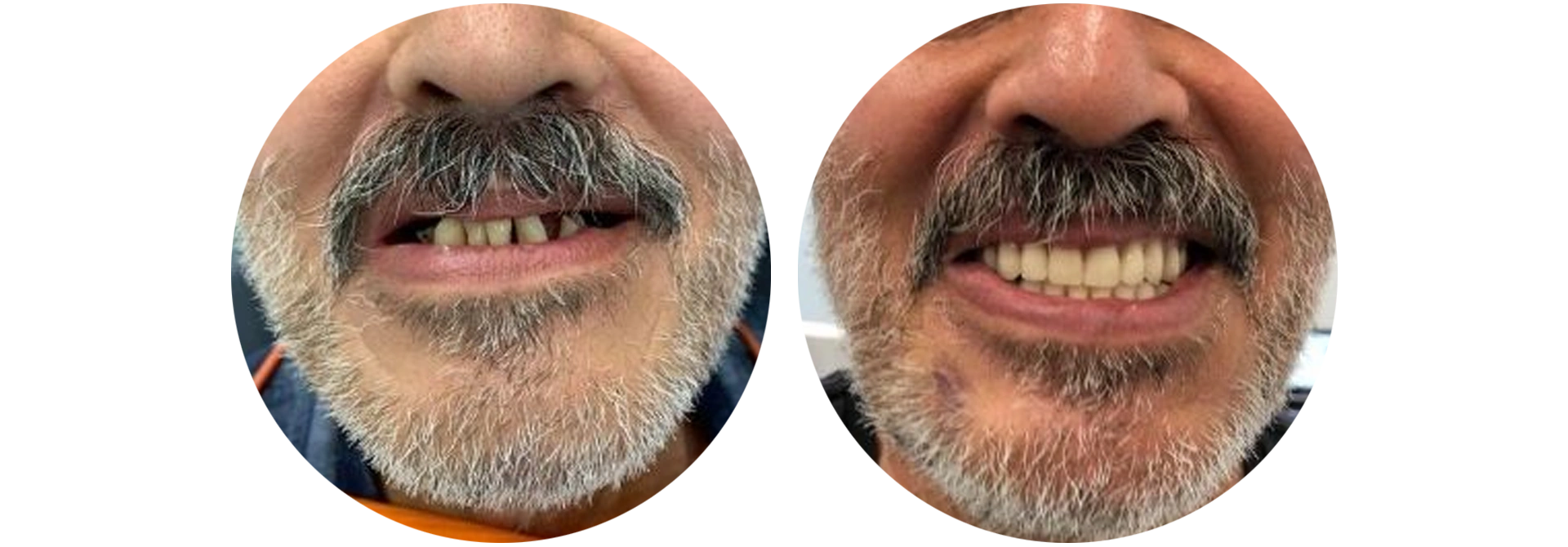 rogzitett-fogsor-velemeny