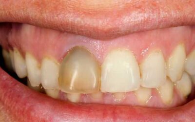 Elhalt fog: mitől szürkül el egy fog, és hogyan kezelhető?