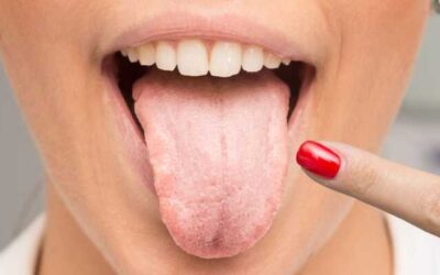 Fehér, lepedékes nyelv – mit üzen a szervezetünk?