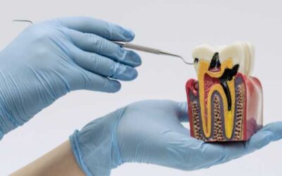 A fogak közötti szuvasodás tünetei és kezelési módja